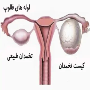 برداشت کیست تخمدان | دکتر شیوا هورشاد