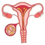 فیبروم چیست و درمان آن | دکتر شیوا هورشاد