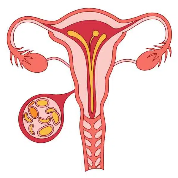 فیبروم چیست و درمان آن | دکتر شیوا هورشاد