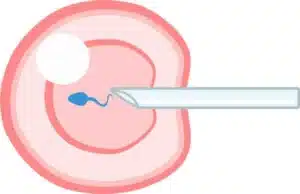 ivf چیست؟ | دکتر شیوا هورشاد