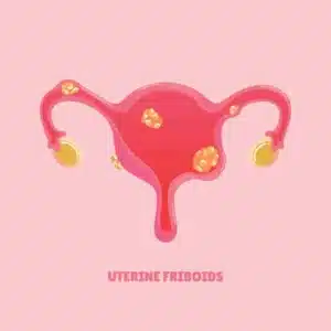 فیبروم چیست و درمان آن | دکتر شیوا هورشاد